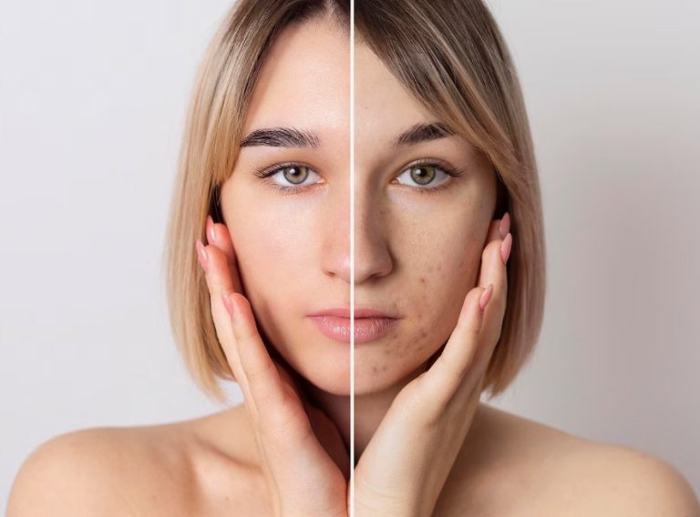 Mujer con acne, antes y despues de los tratamientos